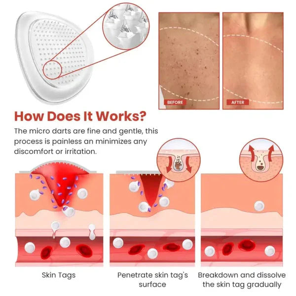 DermaSmooth Skin Tag Remover Patch – Fast, Safe, And Painless Skin Tag And Mole Removal Solution With No Scarring Or Pigmentation